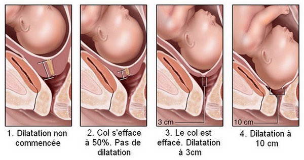 Phase de dilatation avant l'accouchement