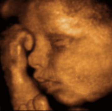 Echographie 3D : visage du foetus