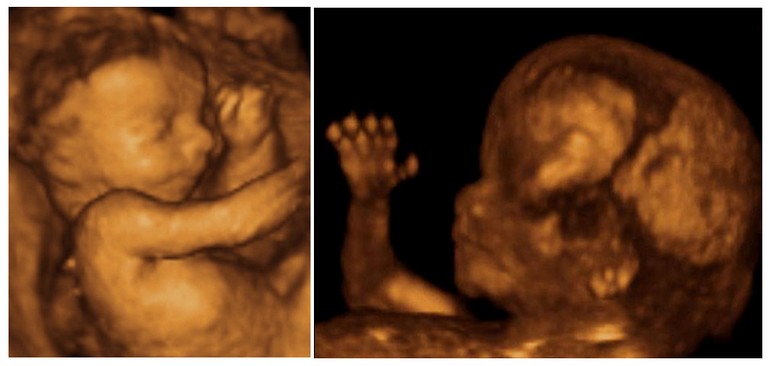 Foetus 15 semaines de grossesse - echographie