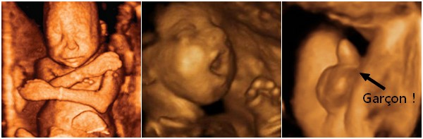 Développement du foetus - 20 semaines de grossesse