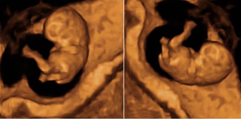 Echographie 8 semaines de grossesse