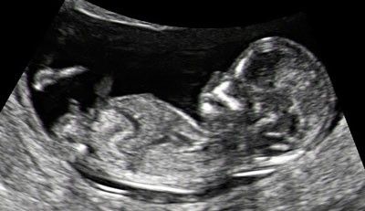 Echographie 11ème semaine de grossesse