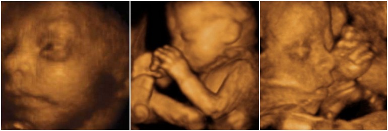 Semaine 24 de grossesse : les yeux du foetus s'ouvrent !