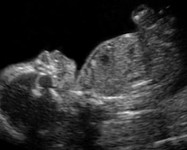 Echographie du foetus à 6 mois de grossesse