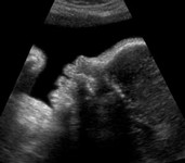 Profil du foetus à 34 SG