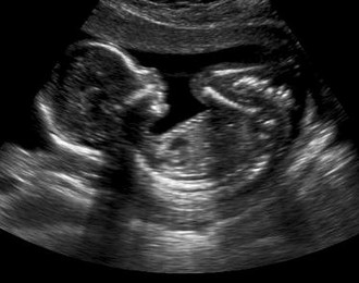 Echographie du 2ème trimestre de grossesse