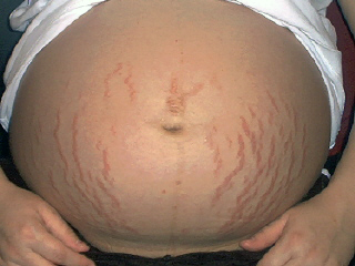 Les vergetures durant la grossesse